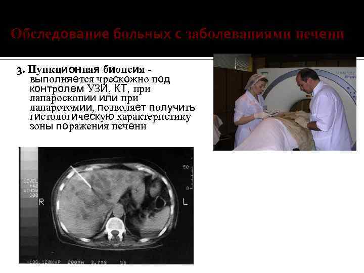 Обследование больных с заболеваниями печени 3. Пункционная биопсия выполняется чрескожно под контролем УЗИ, КТ,