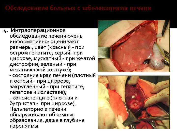 Обследование больных с заболеваниями печени 4. Интраоперационное обследование печени очень информативно: оценивают размеры, цвет