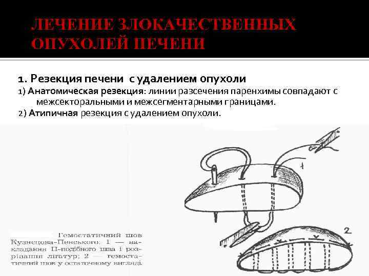 ЛЕЧЕНИЕ ЗЛОКАЧЕСТВЕННЫХ ОПУХОЛЕЙ ПЕЧЕНИ 1. Резекция печени с удалением опухоли 1) Анатомическая резекция: линии
