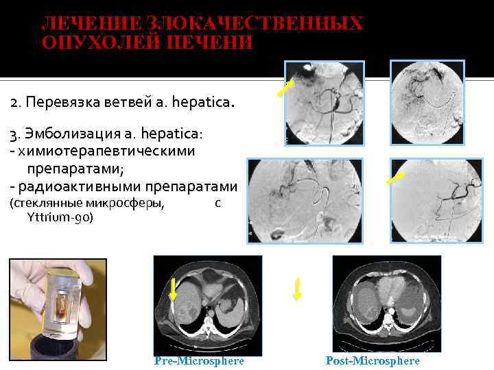 ЛЕЧЕНИЕ ЗЛОКАЧЕСТВЕННЫХ ОПУХОЛЕЙ ПЕЧЕНИ 2. Перевязка ветвей а. hерatiса. 3. Эмболизация а. hераtiса: химиотерапевтическими