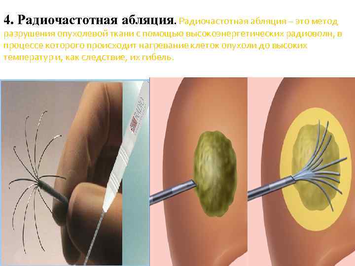 Радиочастотная термоабляция. Радиочастотная катетерная абляция. Абляция опухоли печени. Радиочастотная абляция опухоли. Радио частотная аблация.