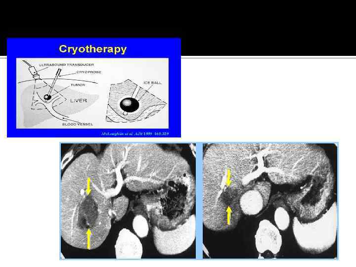 5. Криодеструкция. 