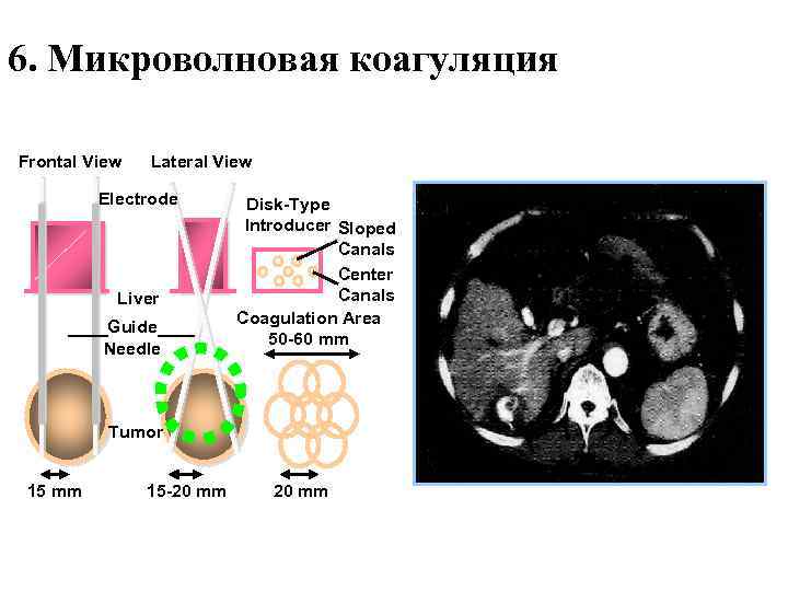 6. Mикроволновая коагуляция Frontal View Lateral View Electrode Liver Guide Needle Disk-Type Introducer Sloped