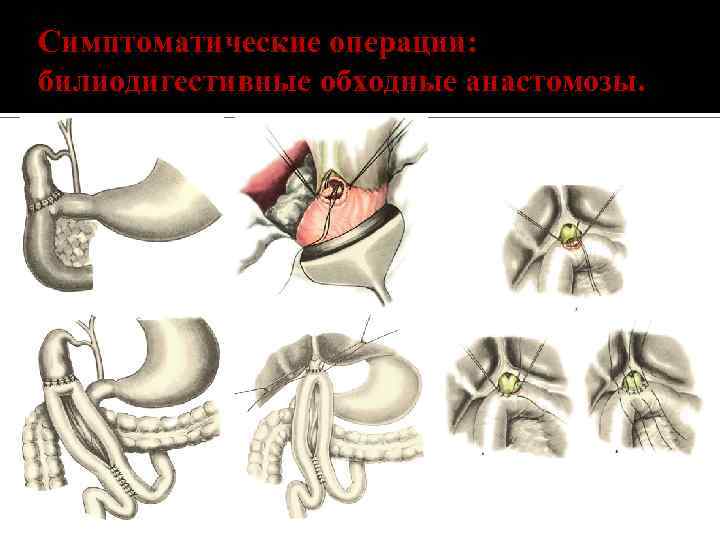 Симптоматические операции: билиодигестивные обходные анастомозы. 