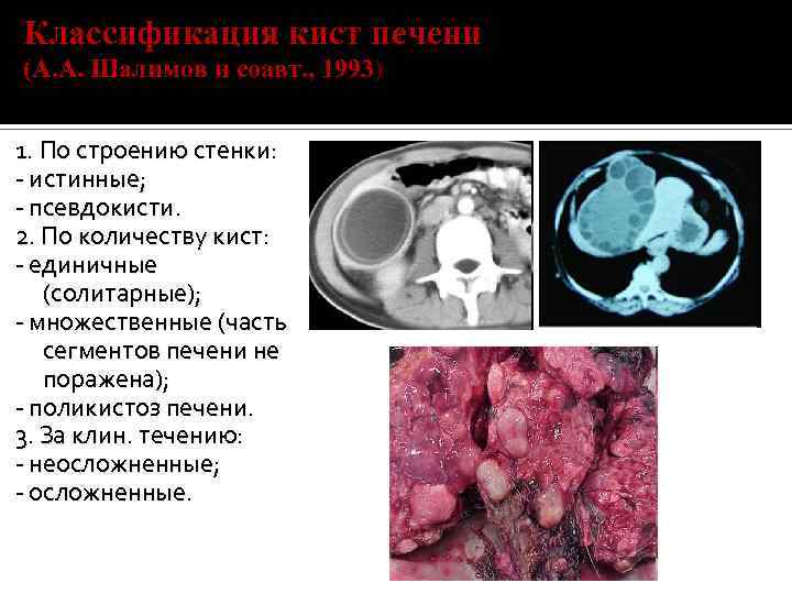 Классификация кист печени (А. А. Шалимов и соавт. , 1993) 1. По строению стенки: