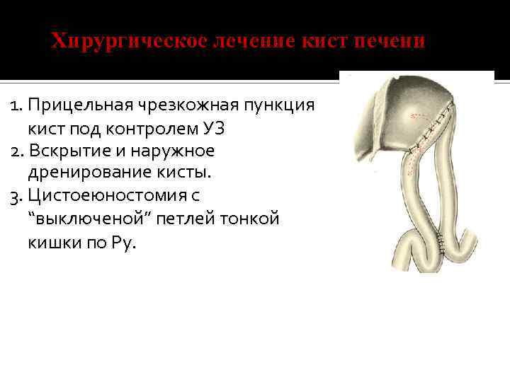 Хирургическое лечение кист печени 1. Прицельная чрезкожная пункция кист под контролем УЗ 2. Вскрытие