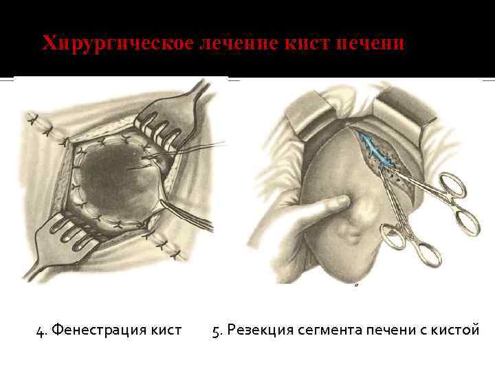 Хирургическое лечение кист печени 4. Фенестрация кист 5. Резекция сегмента печени с кистой 