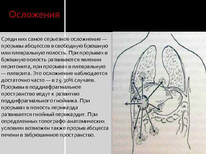 Осложения Среди них самое серьезное осложнение — прорывы абсцессов в свободную брюшную или плевральную
