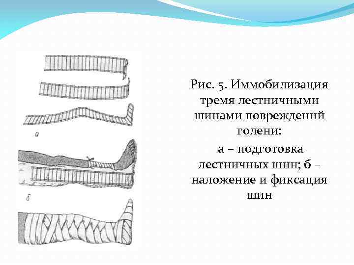 Рис. 5. Иммобилизация тремя лестничными шинами повреждений голени: а – подготовка лестничных шин; б