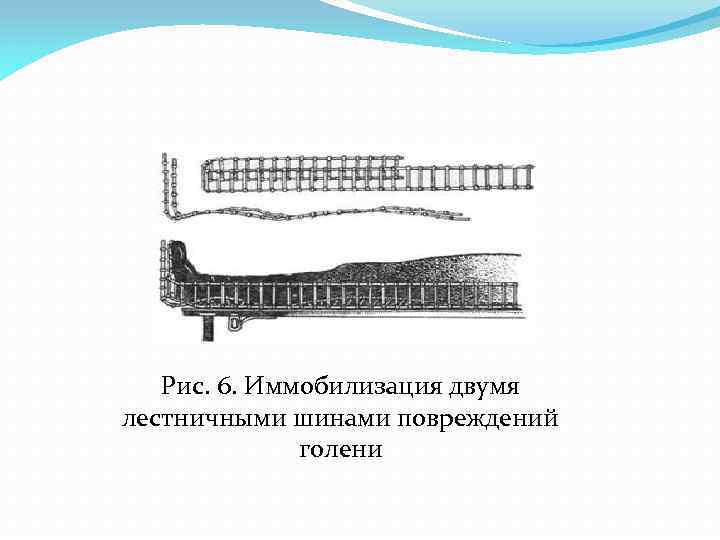 Рис. 6. Иммобилизация двумя лестничными шинами повреждений голени 