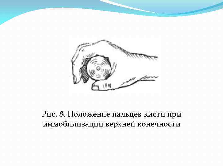 Рис. 8. Положение пальцев кисти при иммобилизации верхней конечности 