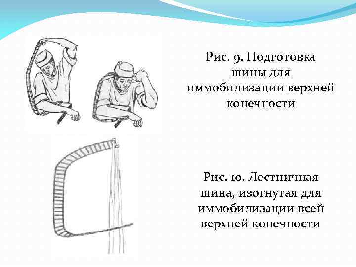 Рис. 9. Подготовка шины для иммобилизации верхней конечности Рис. 10. Лестничная шина, изогнутая для