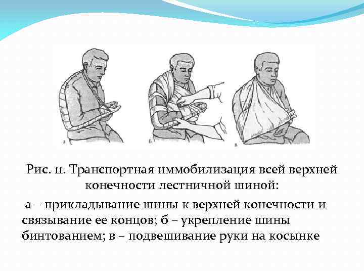 Рис. 11. Транспортная иммобилизация всей верхней конечности лестничной шиной: а – прикладывание шины к