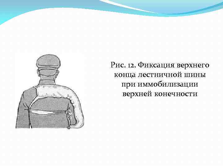 Рис. 12. Фиксация верхнего конца лестничной шины при иммобилизации верхней конечности 