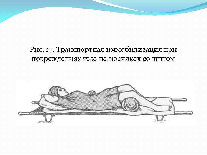 Рис. 14. Транспортная иммобилизация при повреждениях таза на носилках со щитом 