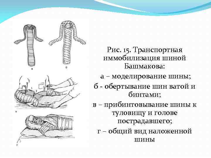 Транспортная иммобилизация шейный отдел позвоночника. Шины Крамера по Башмакову. Иммобилизация шиной Башмакова. Иммобилизация лестничными шинами в виде шины Башмакова. Шина Крамера при переломе позвоночника.