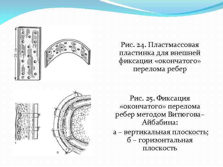 Рис. 24. Пластмассовая пластинка для внешней фиксации «окончатого» перелома ребер Рис. 25. Фиксация «окончатого»