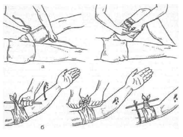 Жгут на конечность при кровотечении. Наложение артериального кровоостанавливающего жгута. Прижатие подколенной артерии. Наложение жгута при ампутации конечности. Давящая повязка на бедренную артерию.