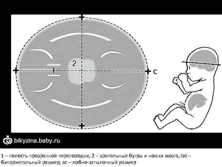 1 – полость прозрачной перегородки, 2 – зрительные бугры и ножки мозга, bd –