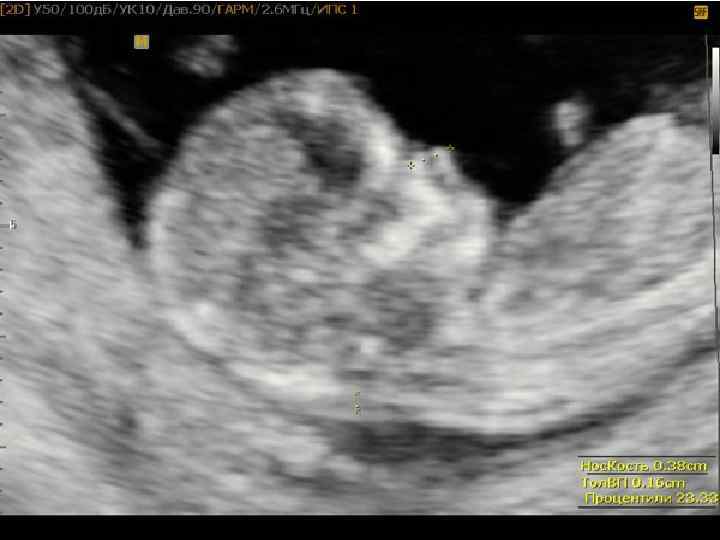 Как выглядит скрининг на 12 неделе беременности фото