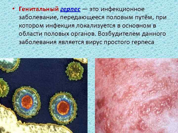  • Генитальный герпес — это инфекционное заболевание, передающееся половым путём, при котором инфекция