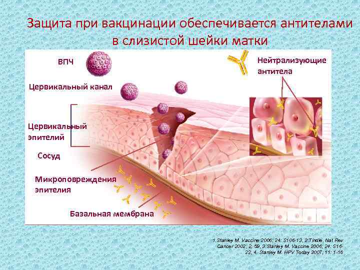 Защита при вакцинации обеспечивается антителами в слизистой шейки матки ВПЧ Нейтрализующие антитела Цервикальный канал