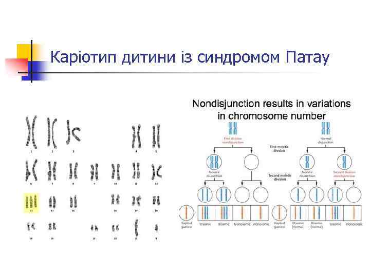 Каріотип дитини із синдромом Патау 