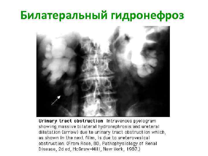 Билатеральный гидронефроз 