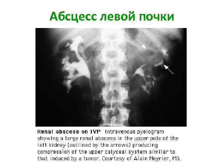 Абсцесс левой почки 