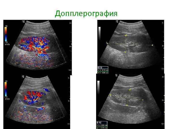 Допплерография 