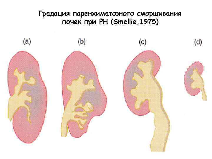 Градация паренхиматозного сморщивания почек при РН (Smellie, 1975) 