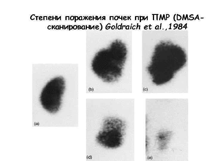 Степени поражения почек при ПМР (DMSAсканирование) Goldraich et al. , 1984 