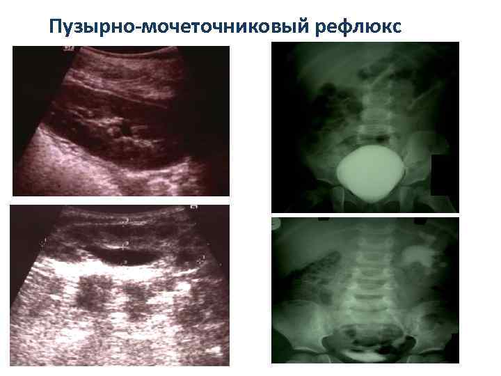 Пузырно-мочеточниковый рефлюкс 