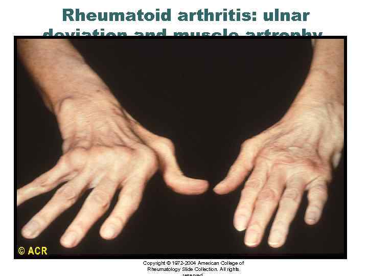 Rheumatoid arthritis: ulnar deviation and muscle artrophy, hands Copyright © 1972 -2004 American College