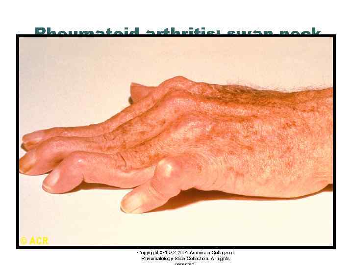 Rheumatoid arthritis: swan-neck and boutonnière deformity, hand Copyright © 1972 -2004 American College of