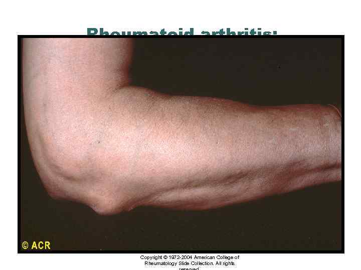 Rheumatoid arthritis: subcutaneous nodule, olecranon Copyright © 1972 -2004 American College of Rheumatology Slide