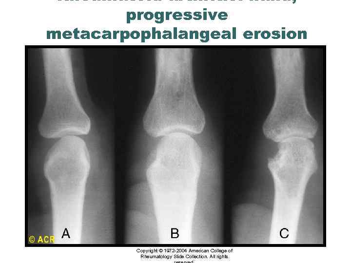 Rheumatoid arthritis: hand, progressive metacarpophalangeal erosion (radiographs) Copyright © 1972 -2004 American College of