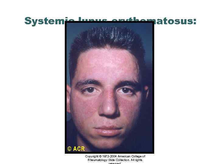 Systemic lupus erythematosus: butterfly rash Copyright © 1972 -2004 American College of Rheumatology Slide