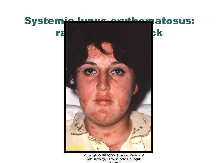 Systemic lupus erythematosus: rash, face and neck Copyright © 1972 -2004 American College of