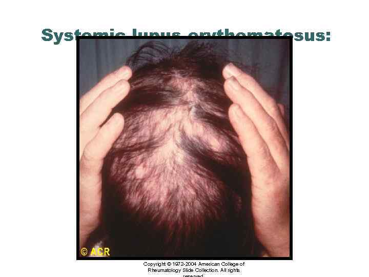 Systemic lupus erythematosus: alopecia, scalp Copyright © 1972 -2004 American College of Rheumatology Slide