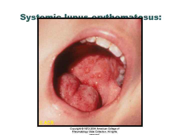 Systemic lupus erythematosus: bullous lesions, palate Copyright © 1972 -2004 American College of Rheumatology