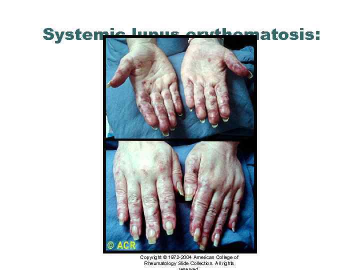 Systemic lupus erythematosis: vasculitis, hands Copyright © 1972 -2004 American College of Rheumatology Slide