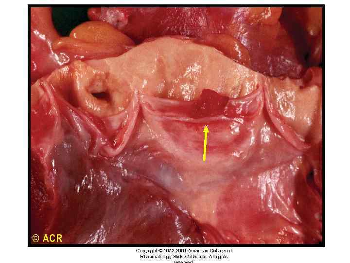 Systemic lupus erythematosus: Libman-Sacks endocarditis, aortic valve (gross specimen) Copyright © 1972 -2004 American