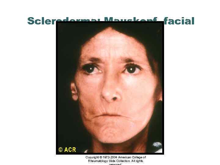 Scleroderma: Mauskopf, facial changes Copyright © 1972 -2004 American College of Rheumatology Slide Collection.