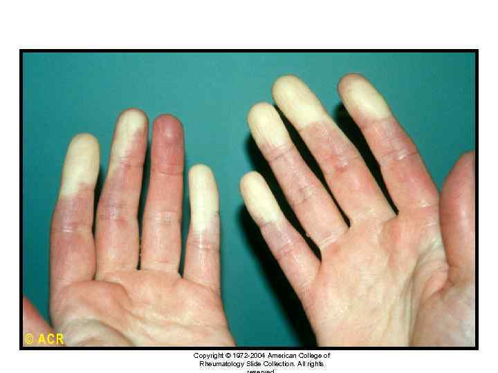 Raynaud’s phenomenon: hands Copyright © 1972 -2004 American College of Rheumatology Slide Collection. All