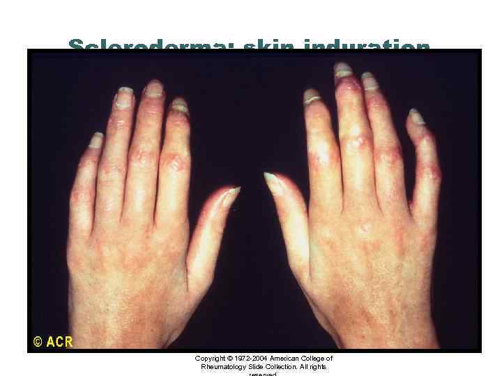 Scleroderma: skin induration, hands Copyright © 1972 -2004 American College of Rheumatology Slide Collection.