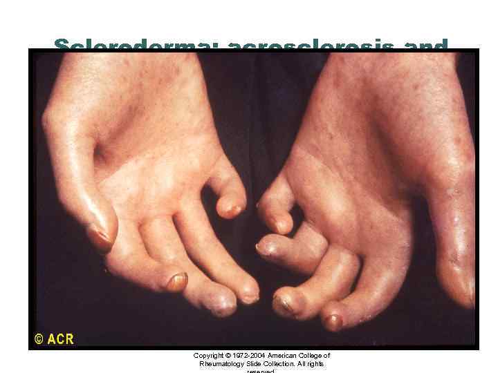 Scleroderma: acrosclerosis and terminal digit resorption Copyright © 1972 -2004 American College of Rheumatology