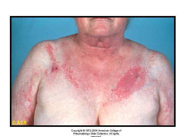 Dermatomyositis: rash, chest Copyright © 1972 -2004 American College of Rheumatology Slide Collection. All