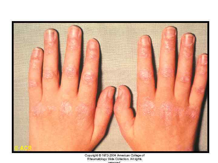 Dermatomyosistis: rash, hands Copyright © 1972 -2004 American College of Rheumatology Slide Collection. All