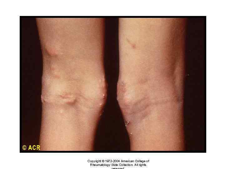 Dermatomyositis: subcutaneous calcification, knees Copyright © 1972 -2004 American College of Rheumatology Slide Collection.